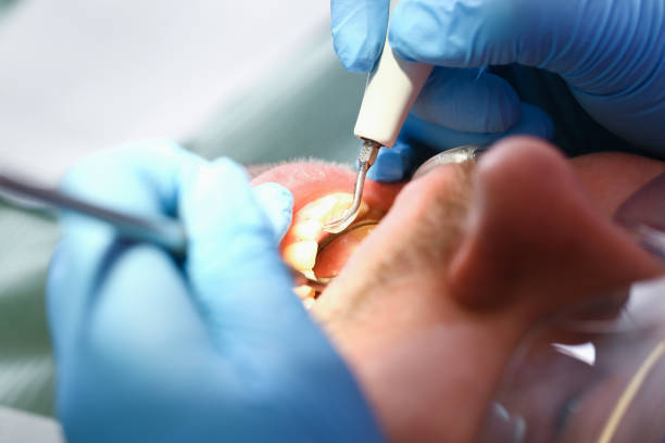 Urgent Tooth Repair in CA